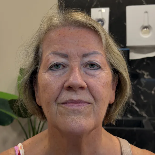 Condição Pré-operatória de excesso de pele palpebral - Antes