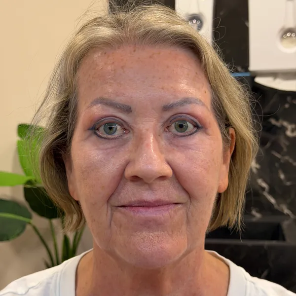 Resultado Pós-operatório de Blefaroplastia Superior a Laser - Depois
