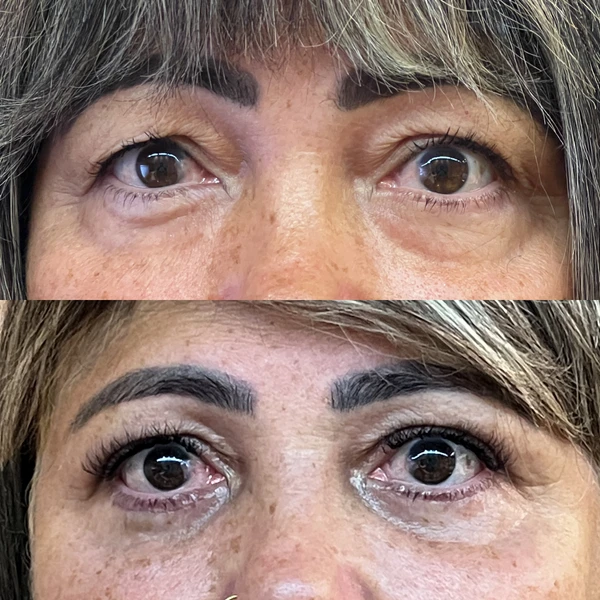 Resultado Clínico de Blefaroplastia #1 - Dr. Daniel Guedes Cirurgião Oftalmologista CRM-PB 8396 Caso Clínico #1 de Blefaroplastia e Rejuvenescimento do Olhar - Dr. Daniel Guedes em João Pessoa