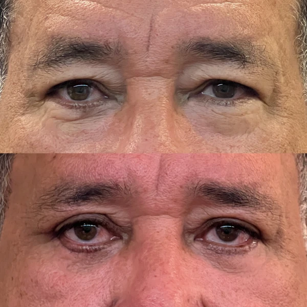Resultado Clínico de Blefaroplastia #2 - Dr. Daniel Guedes Cirurgião Oftalmologista CRM-PB 8396 Caso Clínico #2 de Blefaroplastia e Rejuvenescimento do Olhar - Dr. Daniel Guedes em João Pessoa