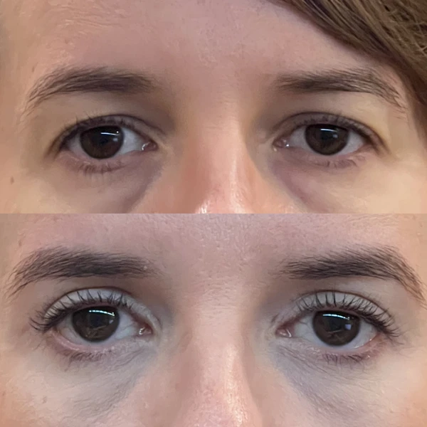 Resultado Clínico de Blefaroplastia #3 - Dr. Daniel Guedes Cirurgião Oftalmologista CRM-PB 8396 Caso Clínico #3 de Blefaroplastia e Rejuvenescimento do Olhar - Dr. Daniel Guedes em João Pessoa