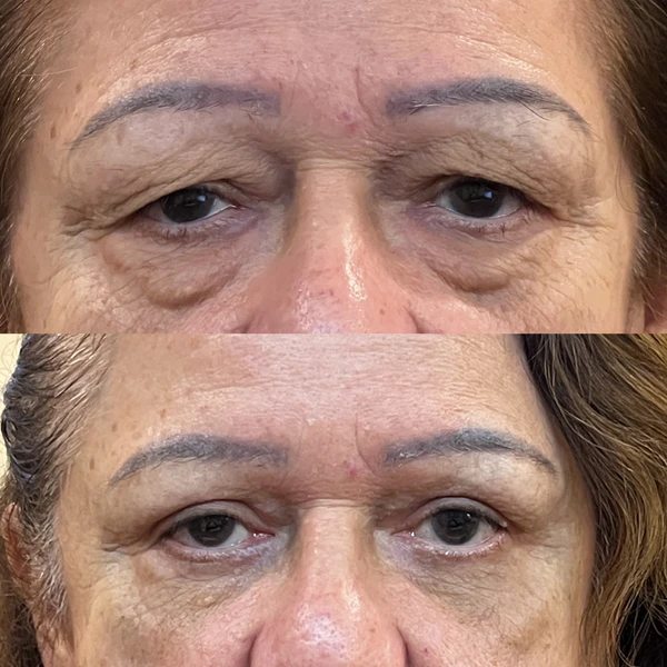 Resultado Clínico de Blefaroplastia #6 - Dr. Daniel Guedes Cirurgião Oftalmologista CRM-PB 8396 Caso Clínico #6 de Blefaroplastia e Rejuvenescimento do Olhar - Dr. Daniel Guedes em João Pessoa