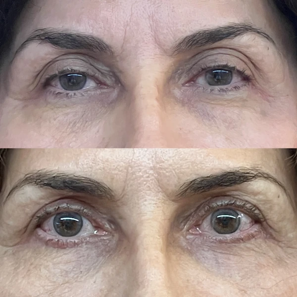 Resultado Clínico de Blefaroplastia #8 - Dr. Daniel Guedes Cirurgião Oftalmologista CRM-PB 8396 Caso Clínico #8 de Blefaroplastia e Rejuvenescimento do Olhar - Dr. Daniel Guedes em João Pessoa