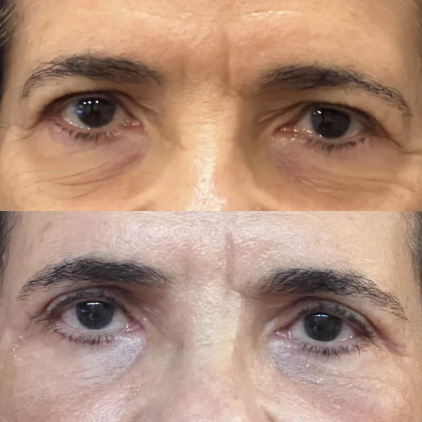 Resultado Clínico de Blefaroplastia #9 - Dr. Daniel Guedes Cirurgião Oftalmologista CRM-PB 8396 Caso Clínico #9 de Blefaroplastia e Rejuvenescimento do Olhar - Dr. Daniel Guedes em João Pessoa